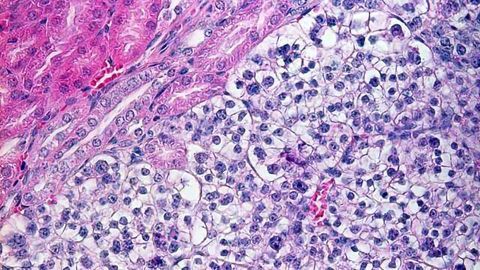 Revealing the Gene Mutations Behind Kidney Cancer