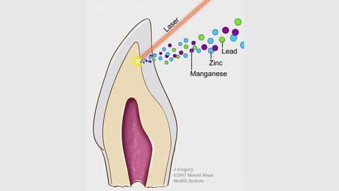Baby Teeth Reveal Genetic and Environmental Causes of Autism