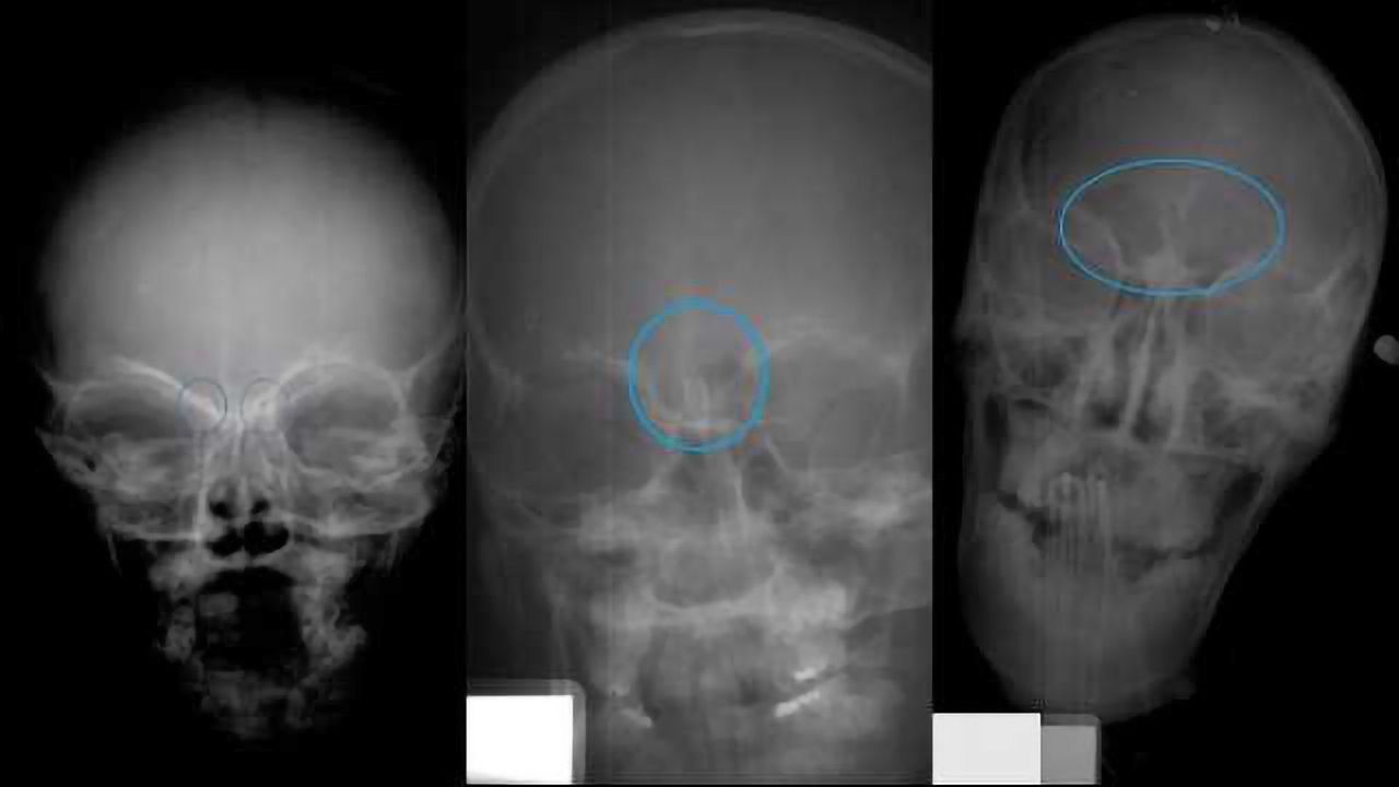 Assessing the Age of Juvenile Remains with Forehead X-Rays