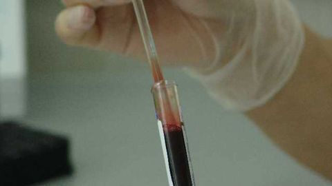 New Three-in-One Blood Test for Prostate Cancer