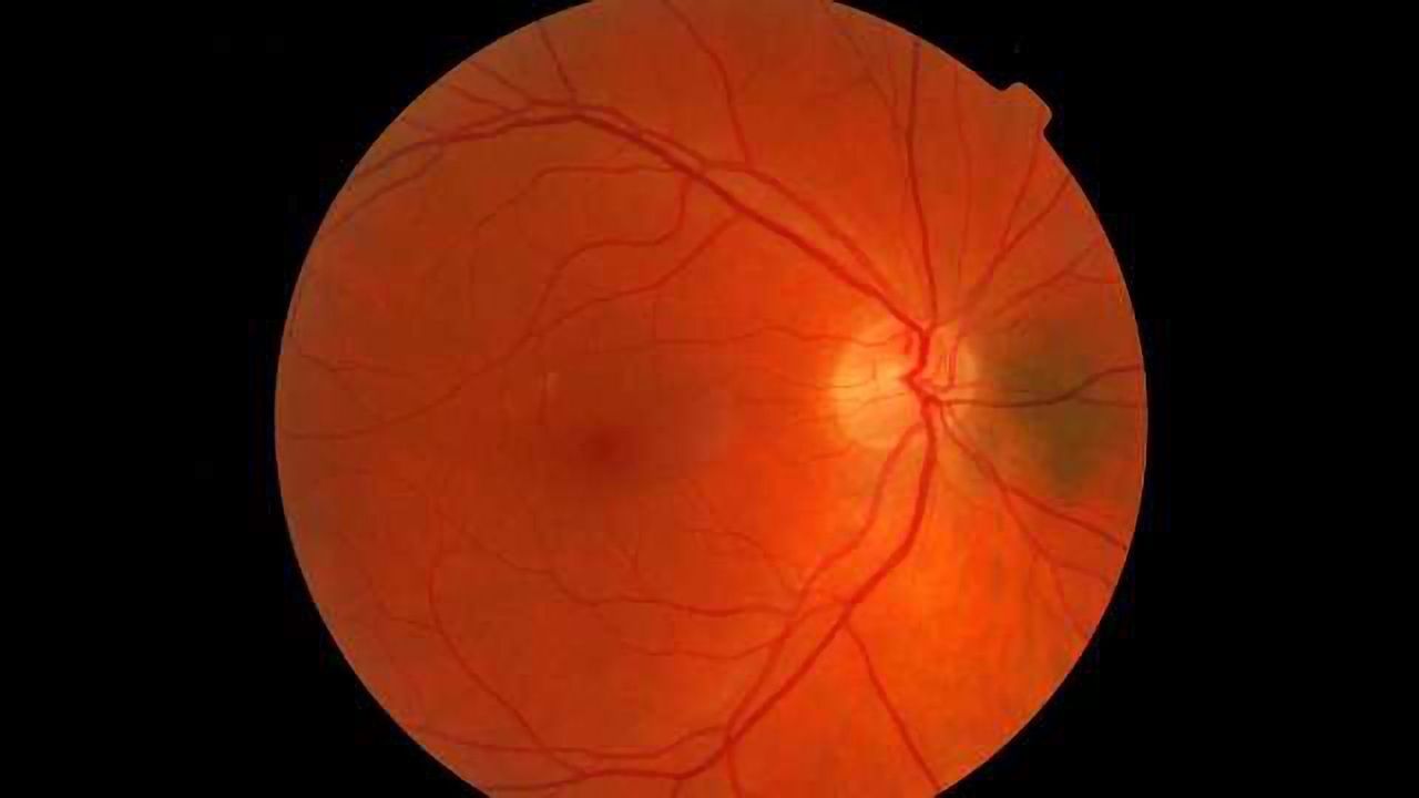 Reproducing a Retinal Disease on a Chip