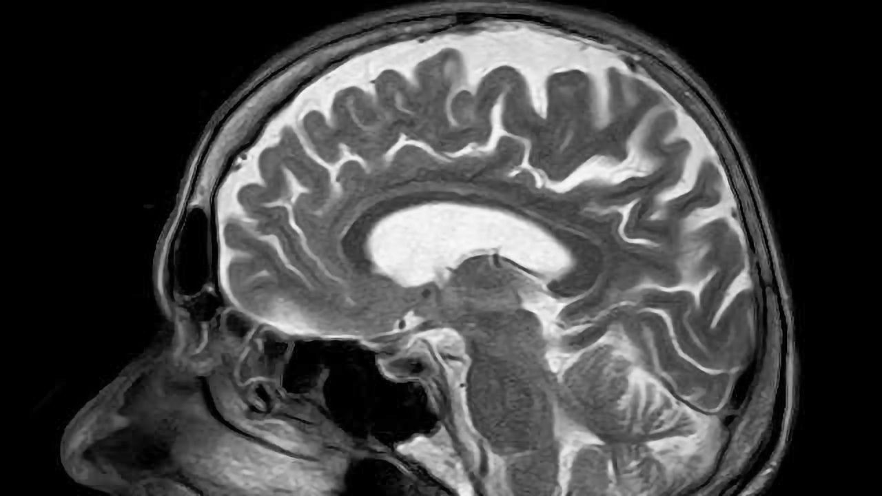 Biological Fingerprint of Tuberculosis Meningitis Discovered in Children