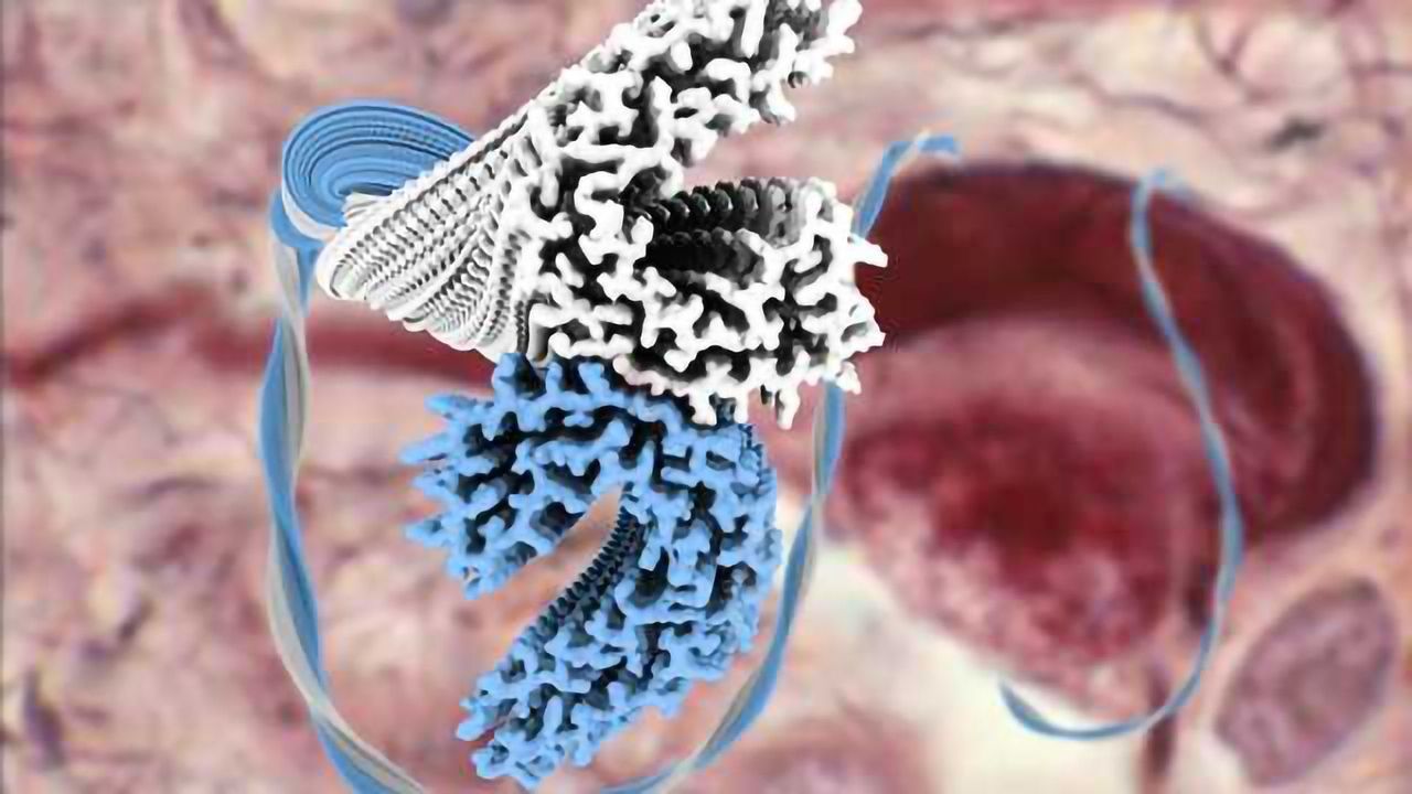 Structure of Tau Filaments from Alzheimer’s Brain Solved by Cryo-EM