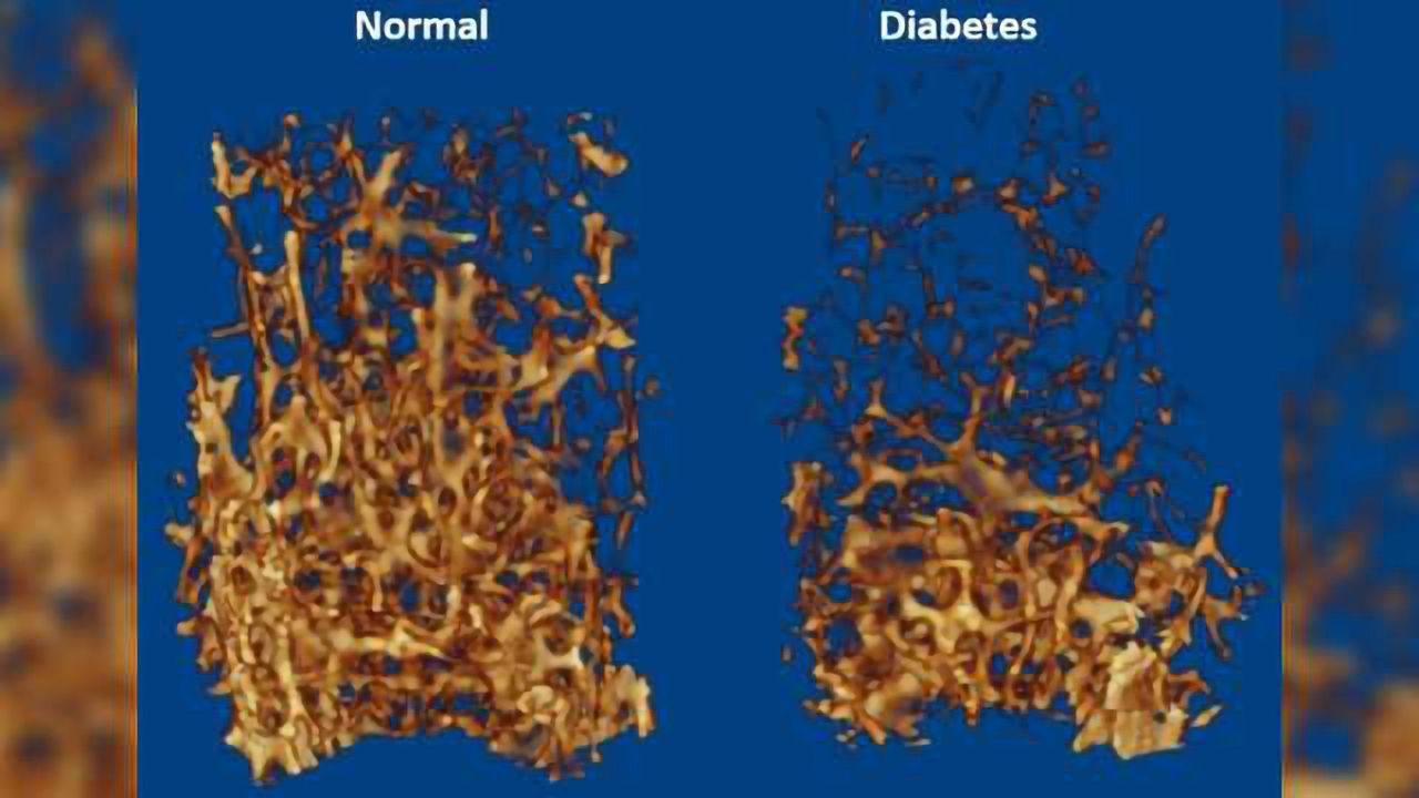 Metabolomic Analysis Reveals Underlying Cause of Weaker Bones in Diabetic Mice