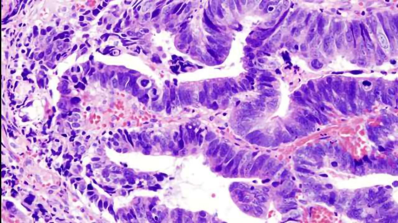 Traditional Model for Cancers Spread Could be Broadly Inappropriate for Many Cancers