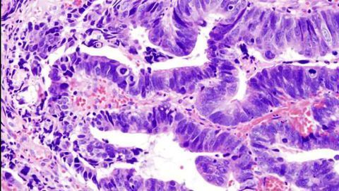Traditional Model for Cancers Spread Could be Broadly Inappropriate for Many Cancers