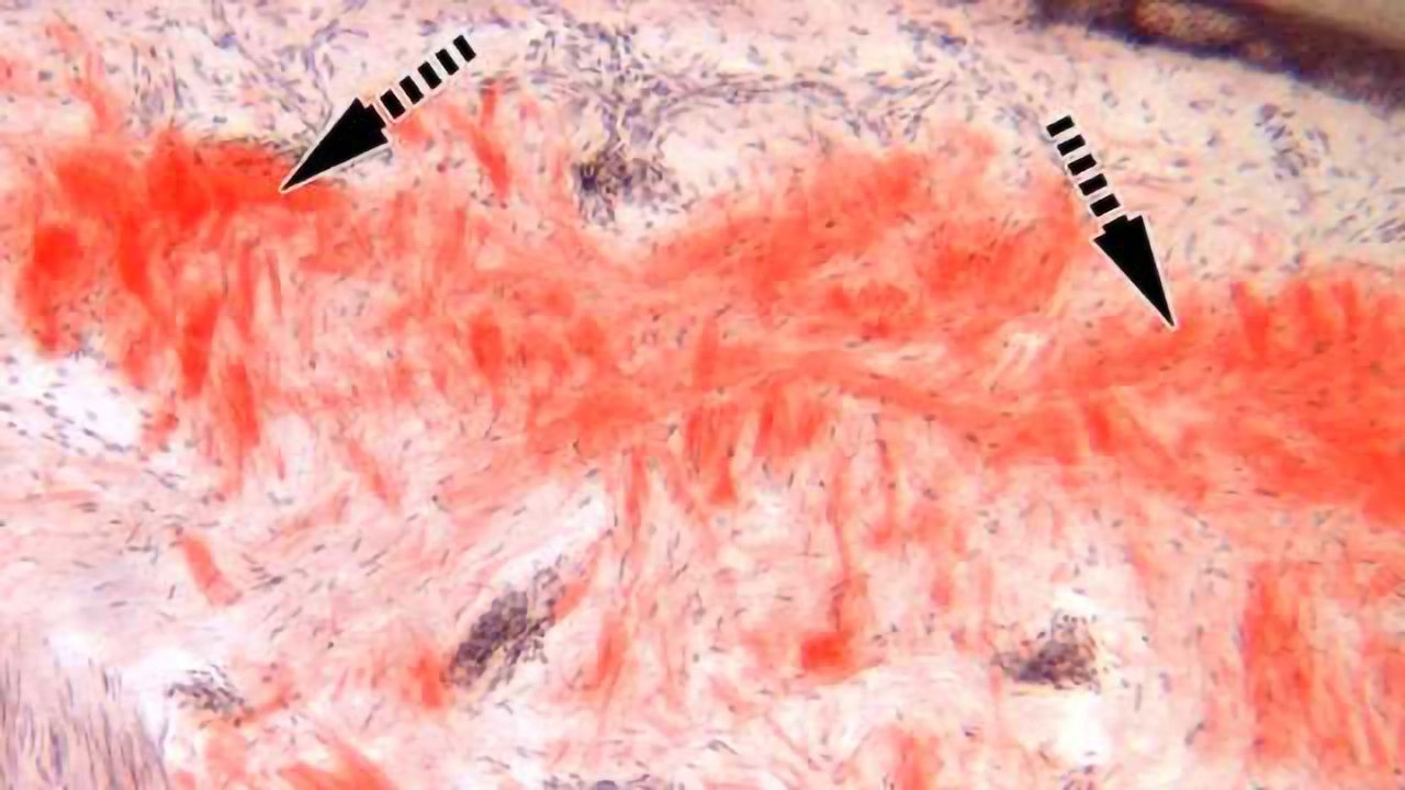 Technique Enables Faster Diagnosis of Inherited Nerve Disease