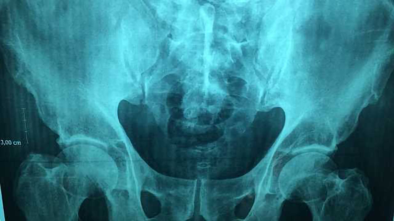 Bone Cancer Drug Targets Tumors, Spares Other Organs