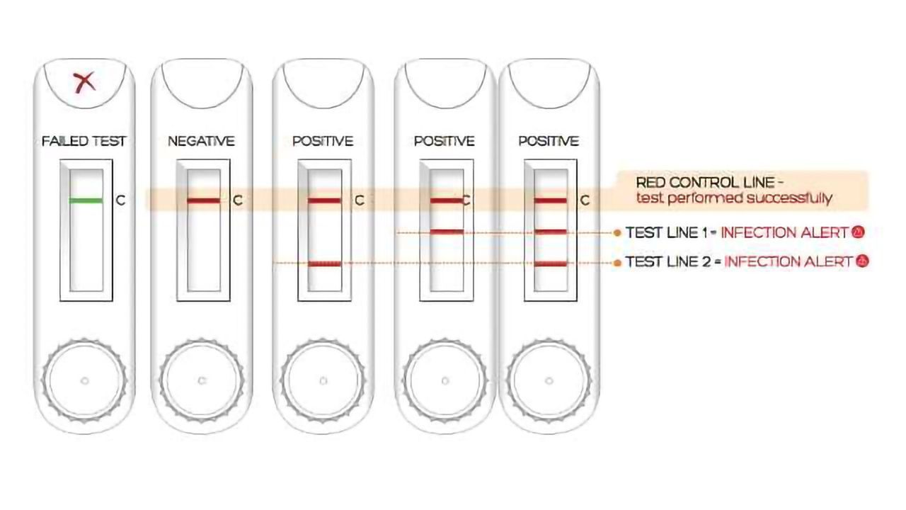 Point-of-Care Testing for Peritoneal Dialysis Patients