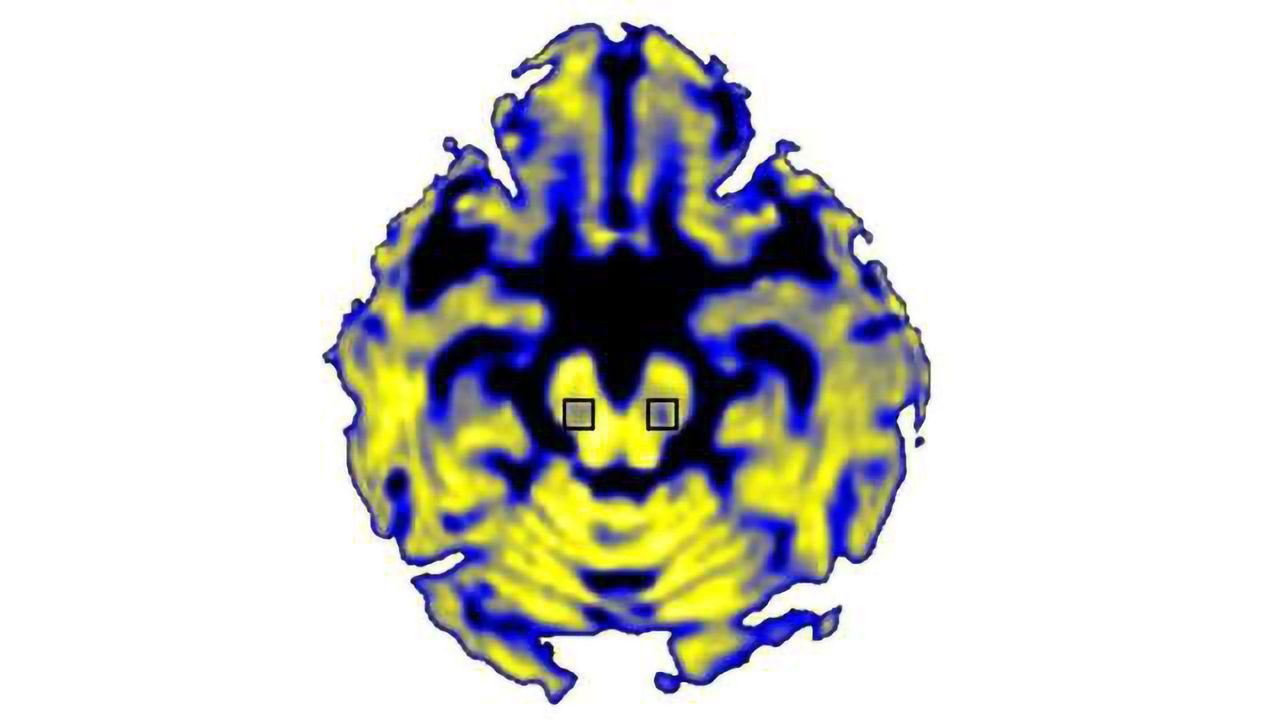 Waterlogged Brain Region Helps Scientists Gauge Damage Caused by Parkinson’s Disease