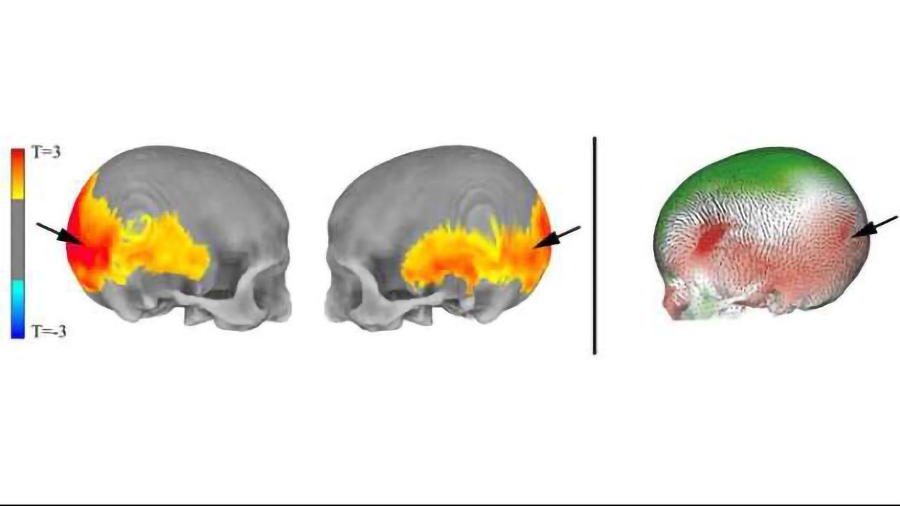 Brain Regions Implicated in Mental Disorders Influenced by Neanderthal Genes