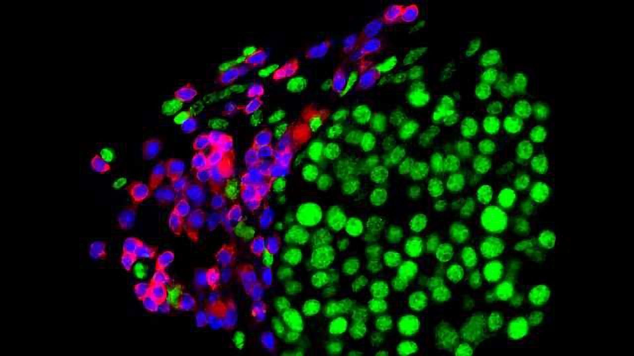 Shedding Light on How Tumors Become Resistant to Immunotherapy
