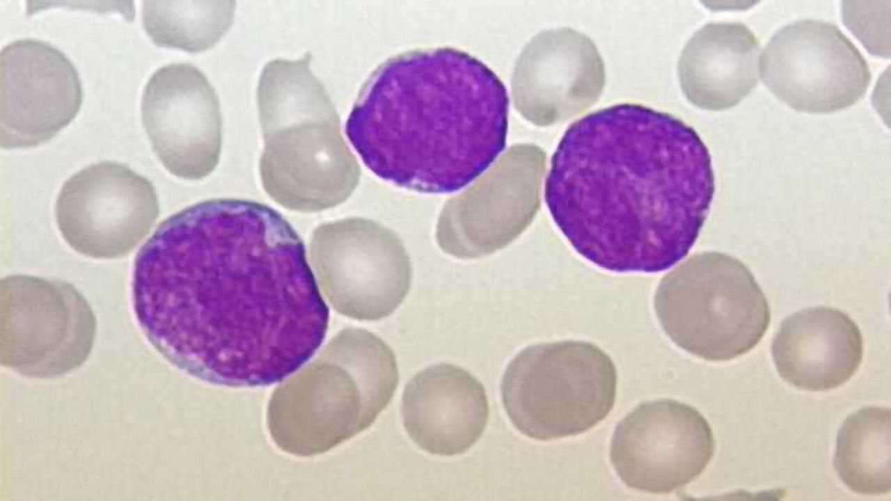FDA Grants Full Approval to Blinatumomab for Acute Lymphoblastic Leukemia