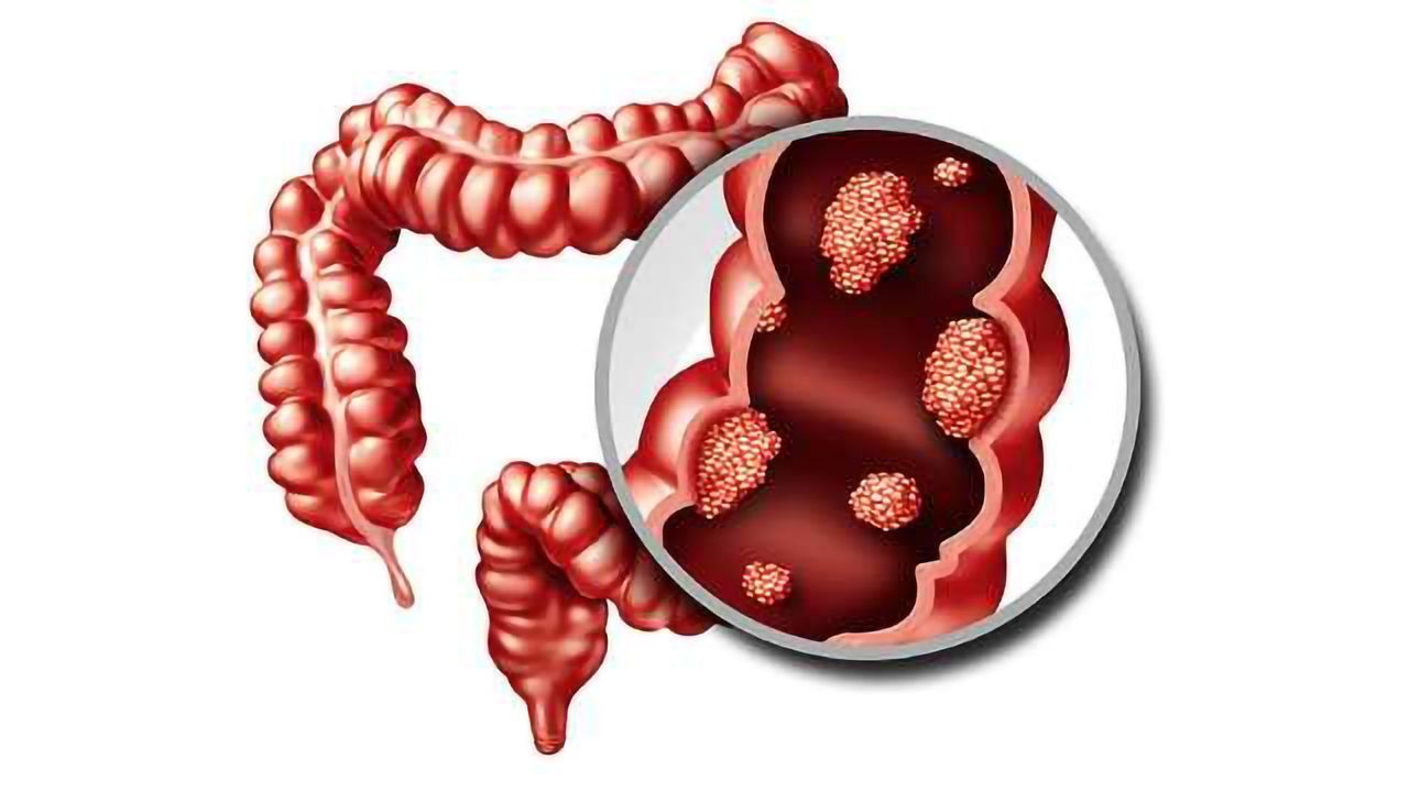 Could This Be a "Silver Bullet" for Preventing and Treating Colon Cancer?