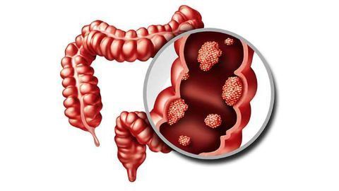Could This Be a "Silver Bullet" for Preventing and Treating Colon Cancer?