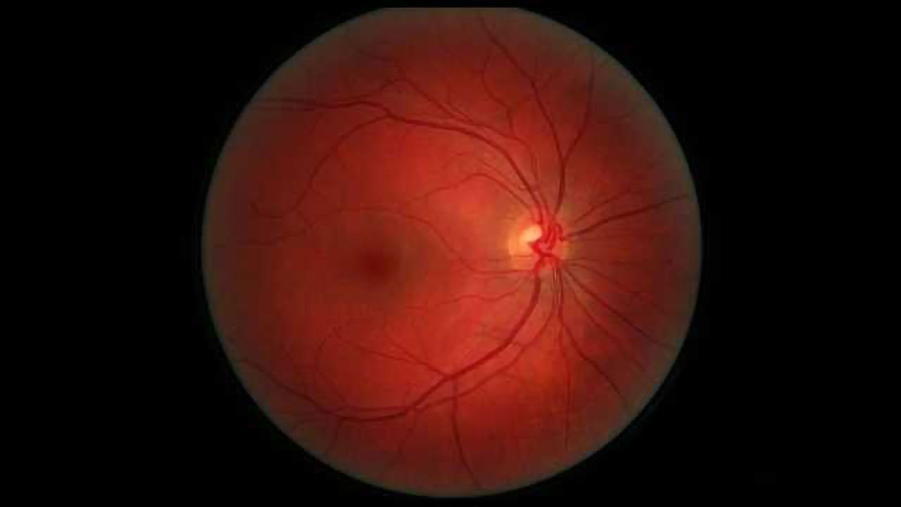 CRISPR Used to Prevent Development of Angiogenesis of the Retina