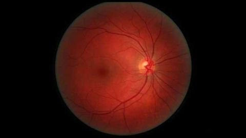CRISPR Used to Prevent Development of Angiogenesis of the Retina
