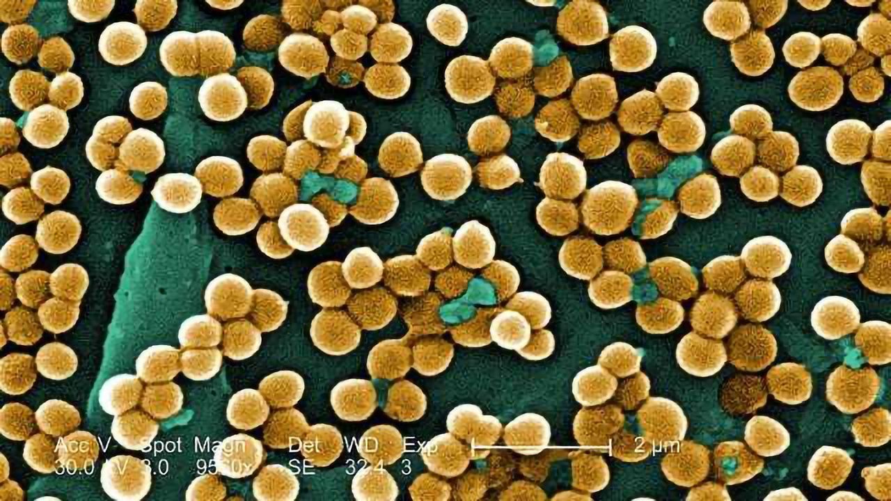 MRSA Survival Chances Predicted by DNA Sequencing