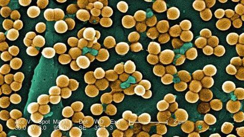 MRSA Survival Chances Predicted by DNA Sequencing
