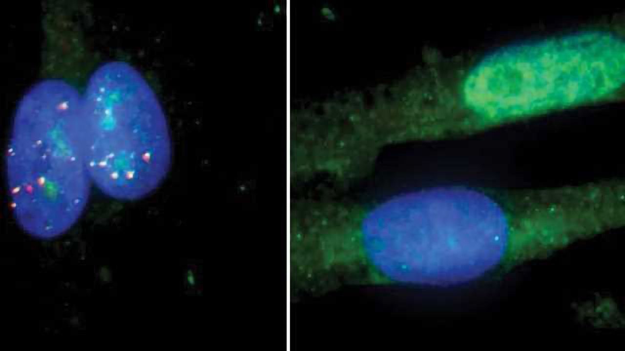 New Version of CRISPR Corrects RNA Defects Linked to Huntington’s, ALS