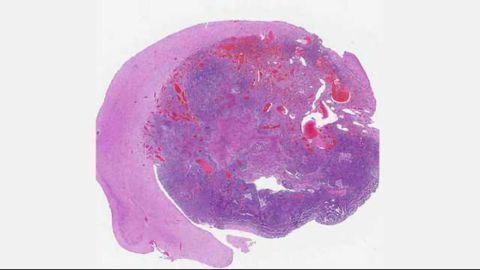 Specific Gene Combinations Linked to Glioblastoma