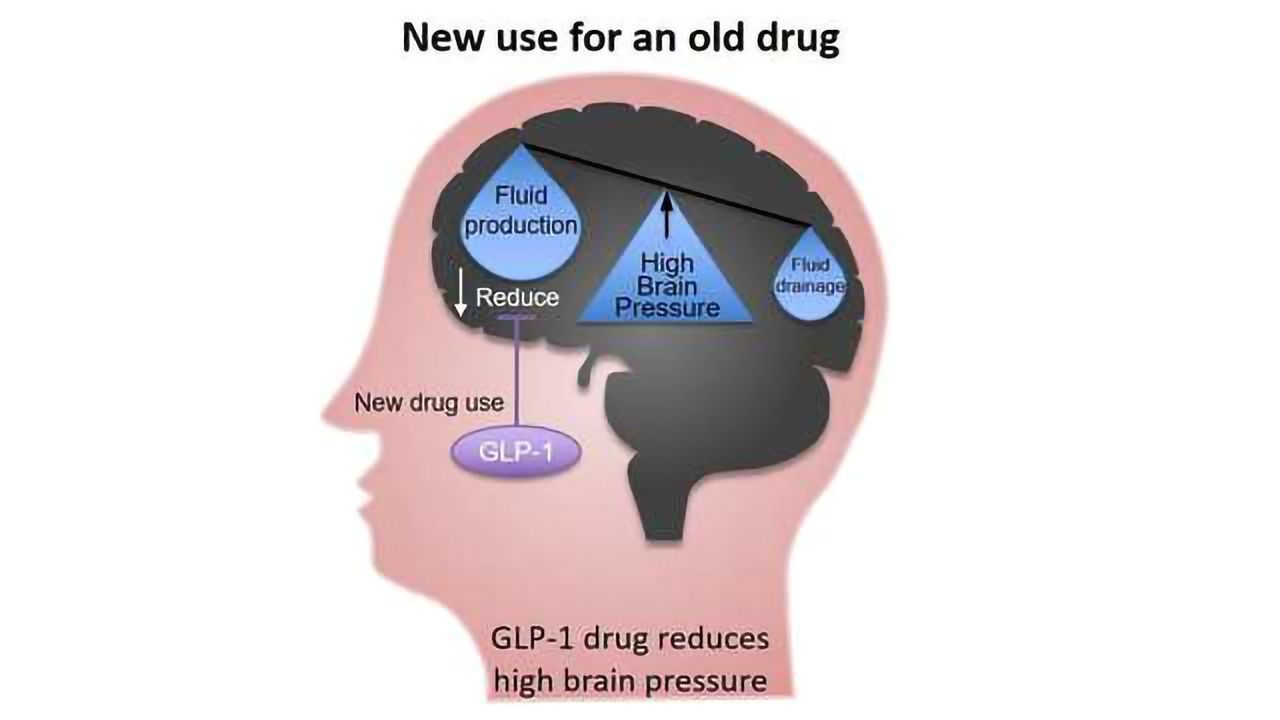 Existing Diabetes Drug Could Lower Brain Pressure