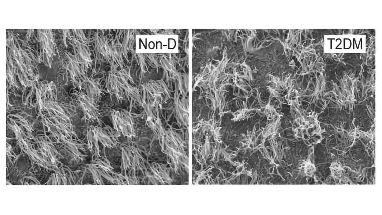 Diabetes Linked With Collapse of Brain Cilia and Impaired Neurogenesis