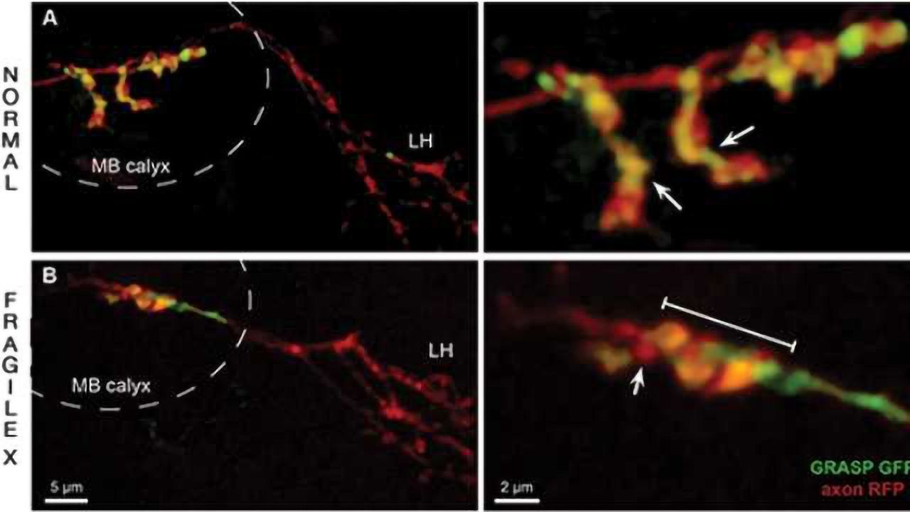 New Research Reinforces Importance of Early Detection for Most Common Heritable Cause of Autism