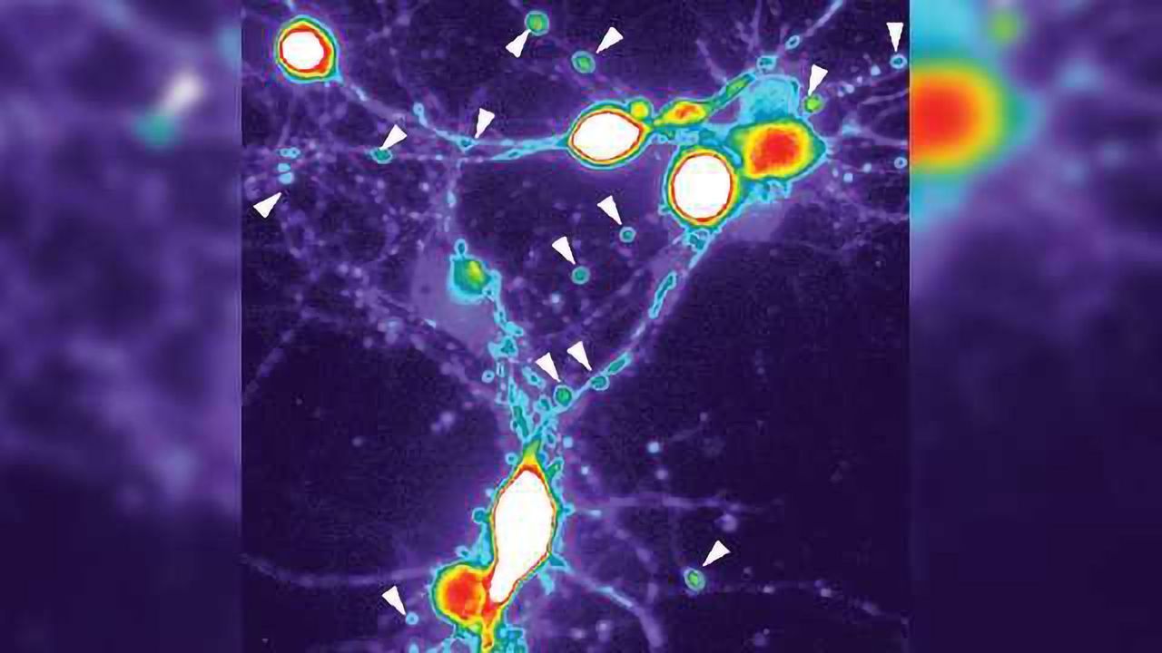 Alzheimer's Pathology: Inflammation induces neuritic beading and accumulation of abnormal tau