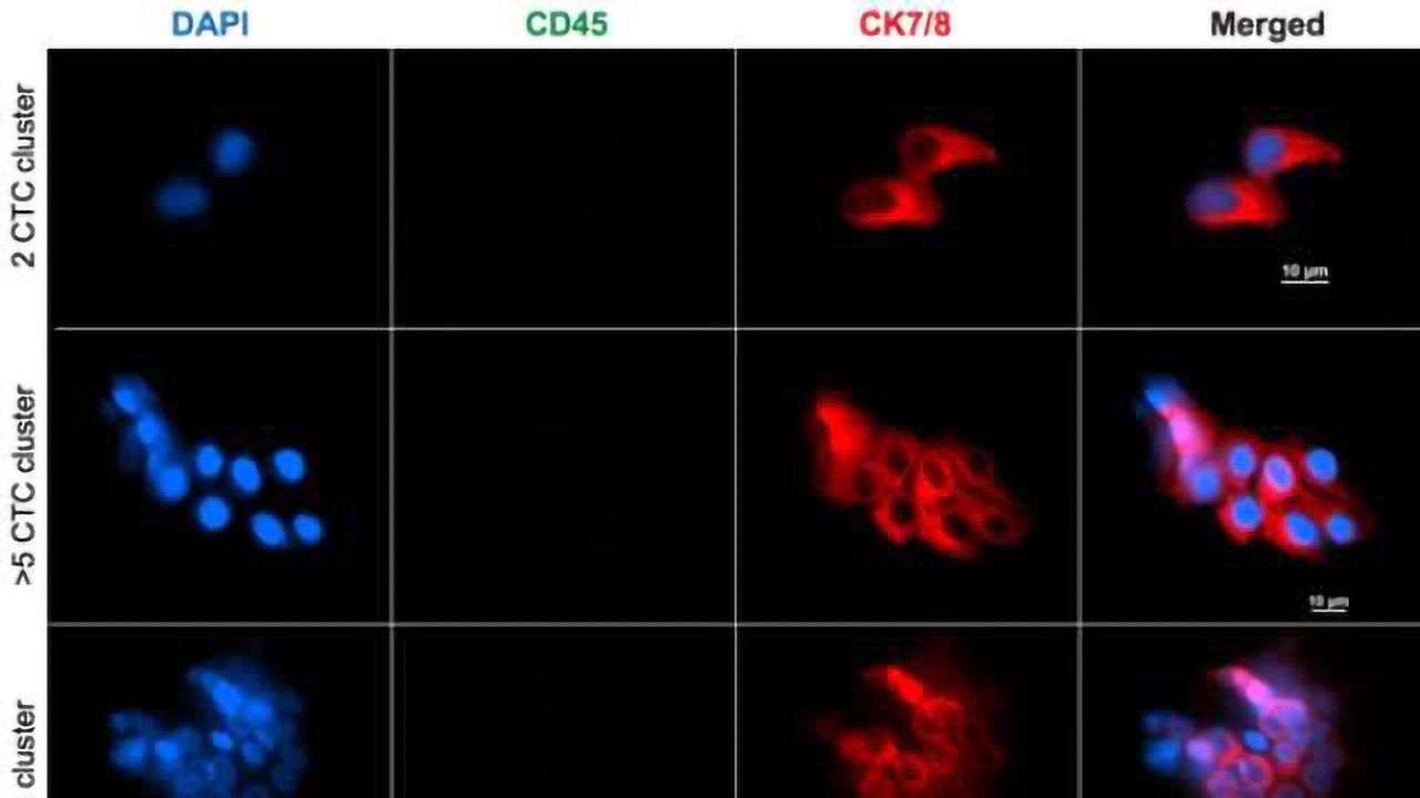 A Blood Test Can Predict Early Lung Cancer Prognosis