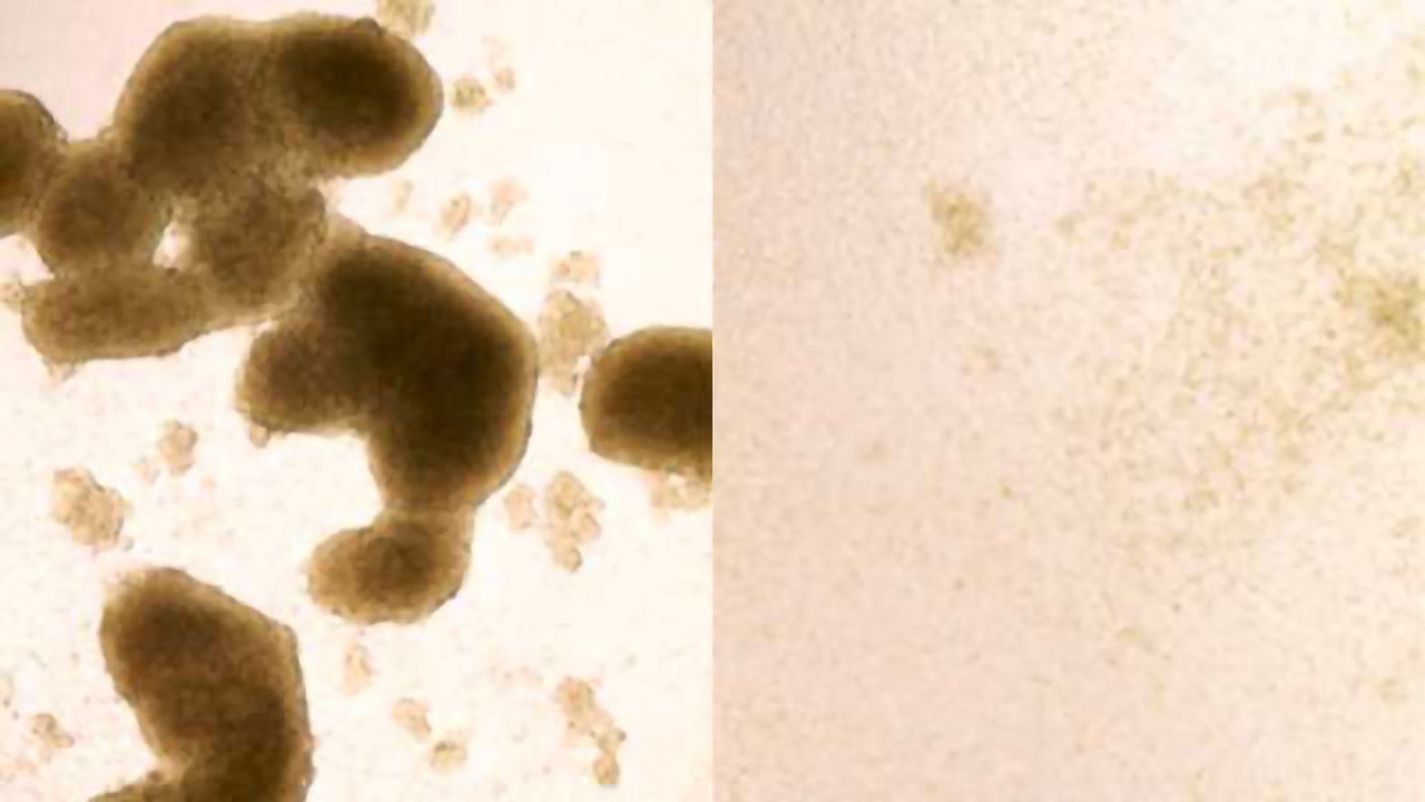 Zika Virus Kills Brain Cancer Stem Cells