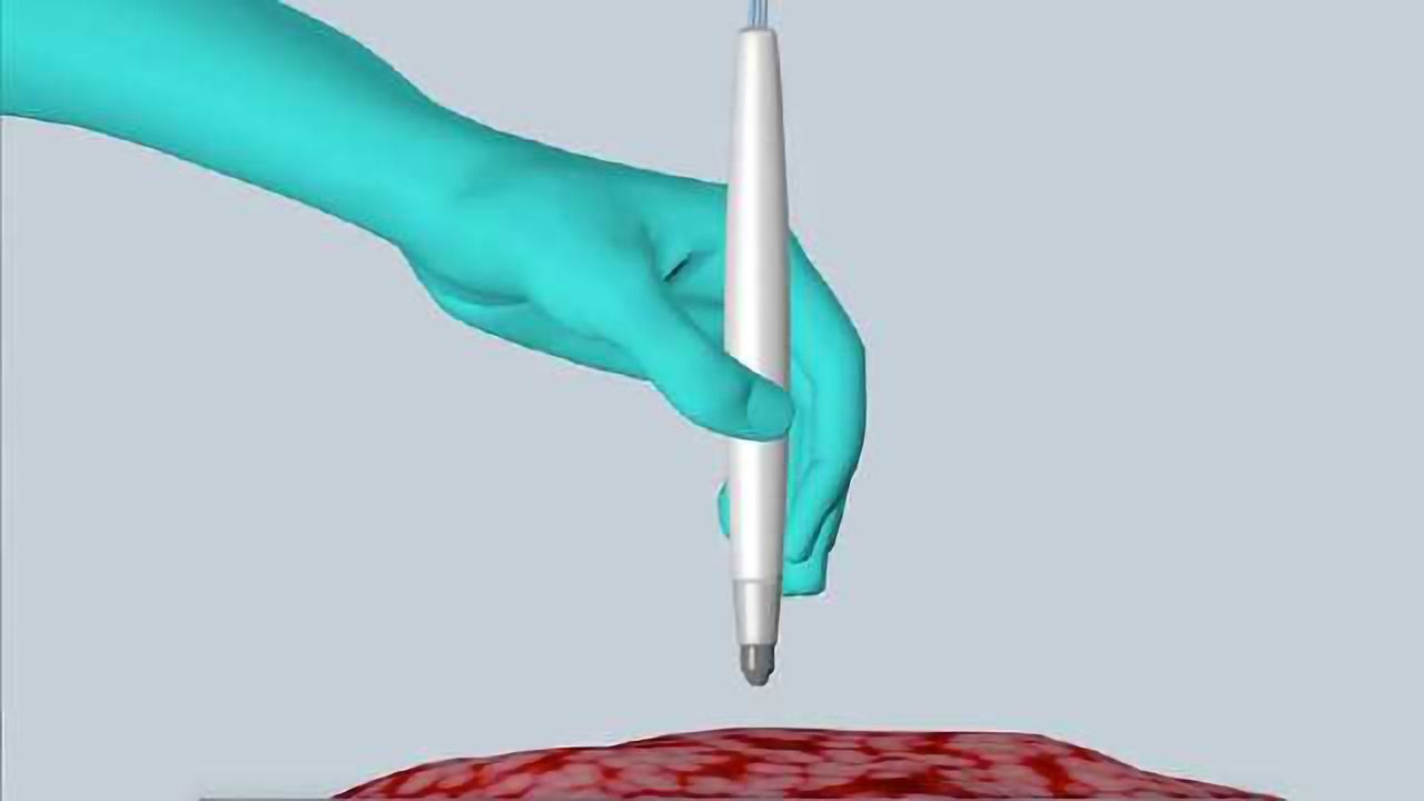 MasSpec Pen Accurately Identifies Cancer in Seconds