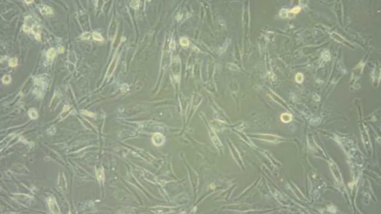 Astrocytoma Cell Repair Genes Linked to Brain Cancer Aggressiveness
