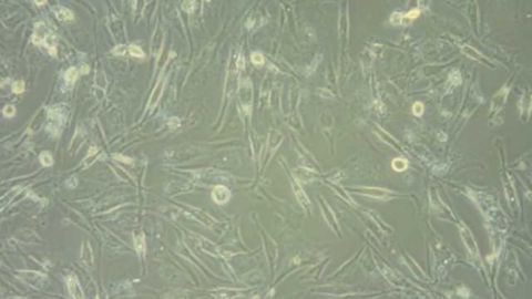 Astrocytoma Cell Repair Genes Linked to Brain Cancer Aggressiveness