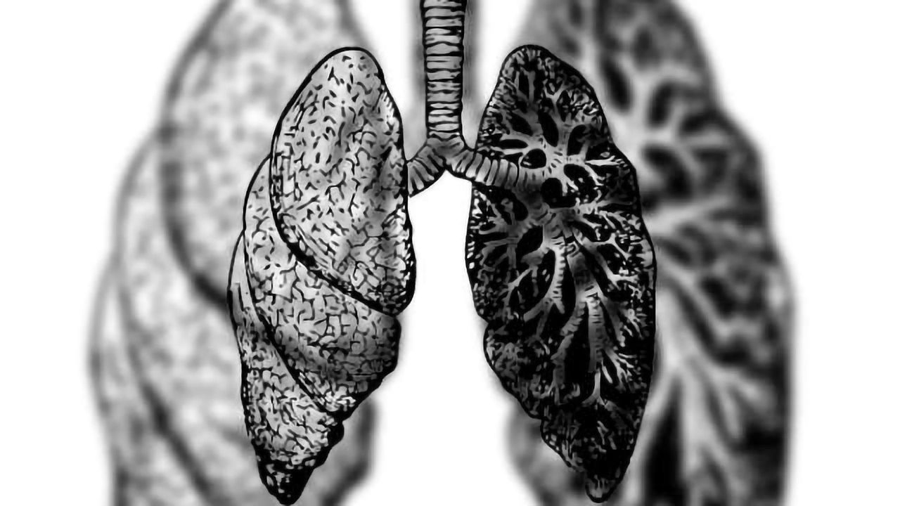 Antibody Treatment Effective in Treatment-Resistant COPD Patients