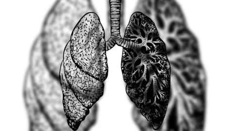 Antibody Treatment Effective in Treatment-Resistant COPD Patients