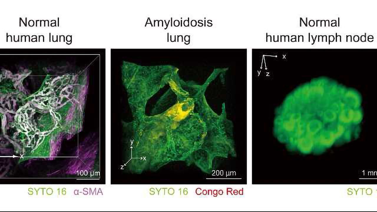 Superior Pathological Diagnosis Using Transparent Tissues