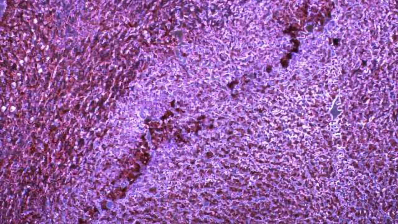 MicroRNA Helps Cancer Evade Immune System