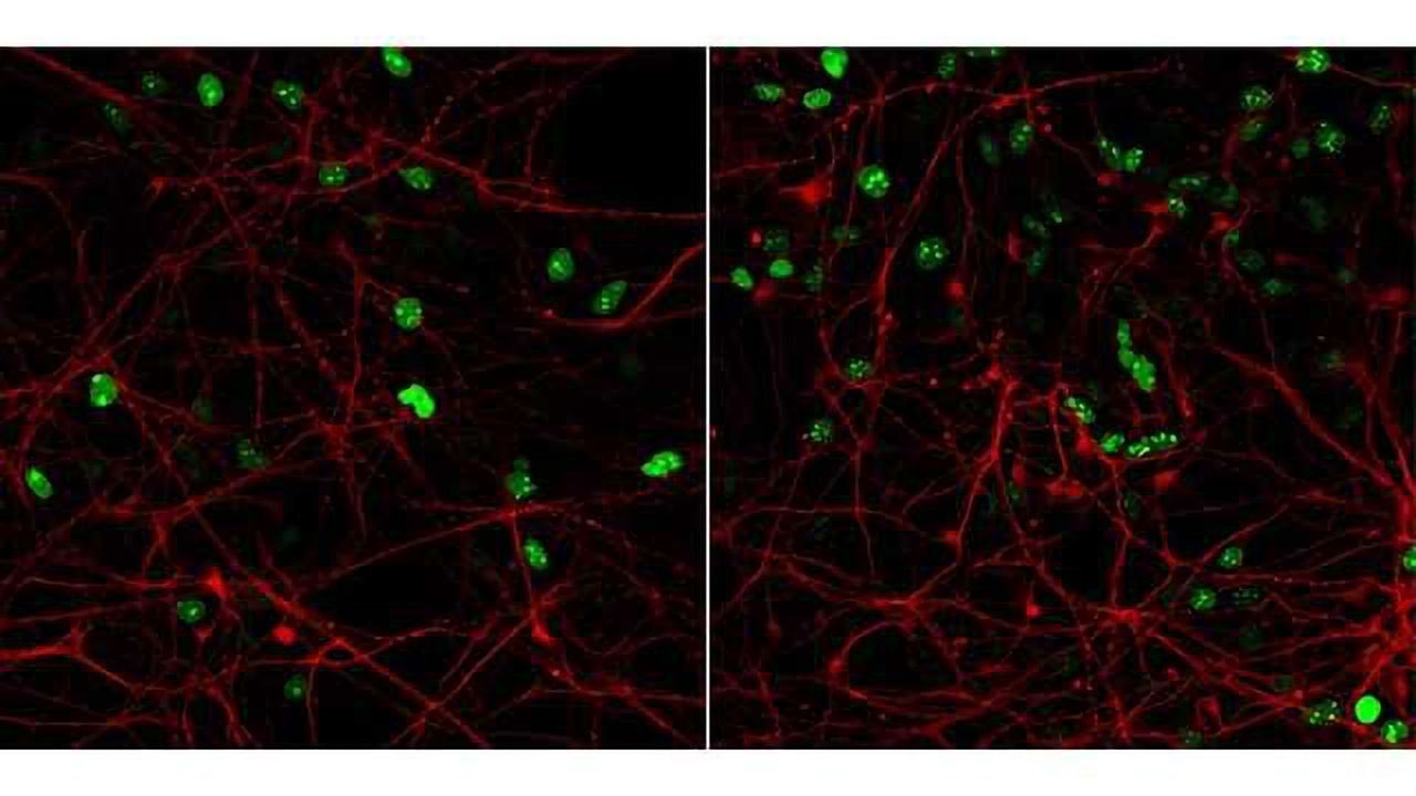 Lissencephaly Modeled in a Dish for the First Time