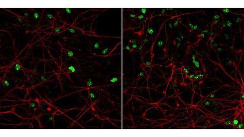 Lissencephaly Modeled in a Dish for the First Time
