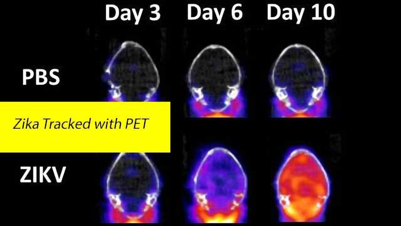 Positron Emission Tomography (PET) Study of Zika Brain Infection