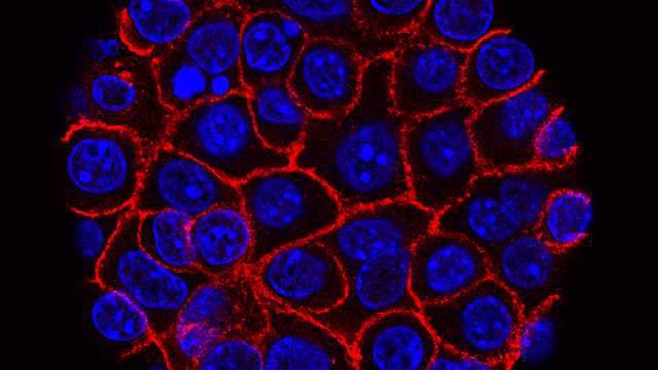 Genetic Test Successfully Detects Some Asymptomatic Pancreatic Cancers