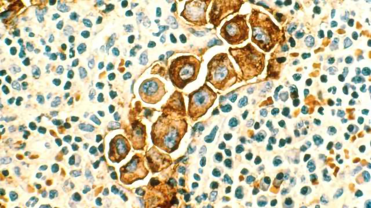 Eliminating Subjectivity in Pathology