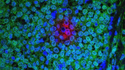 Genetic Targets for Chemo-resistant Breast Cancer Identified