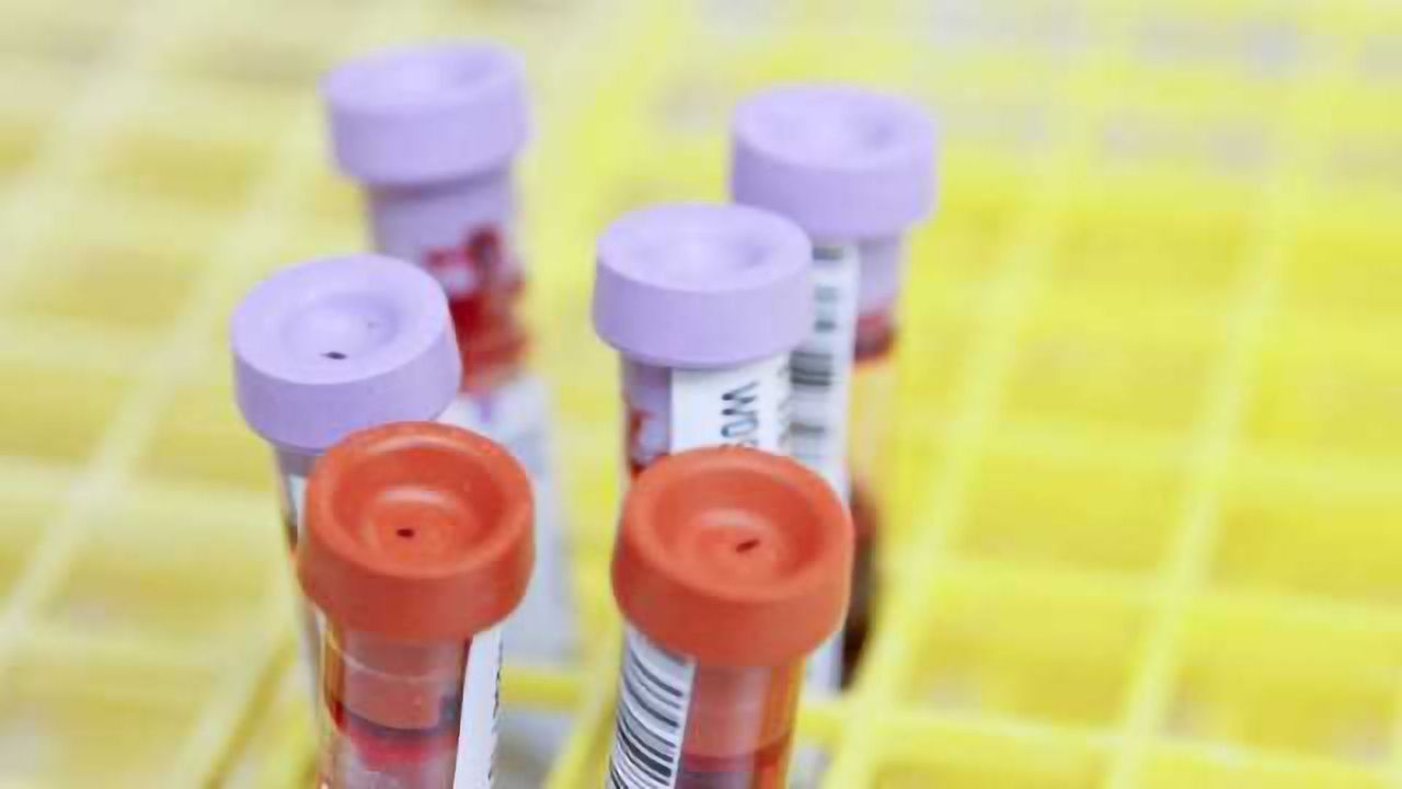 Liquid Biopsy May Be New Way to Detect Liver Cancer Earlier