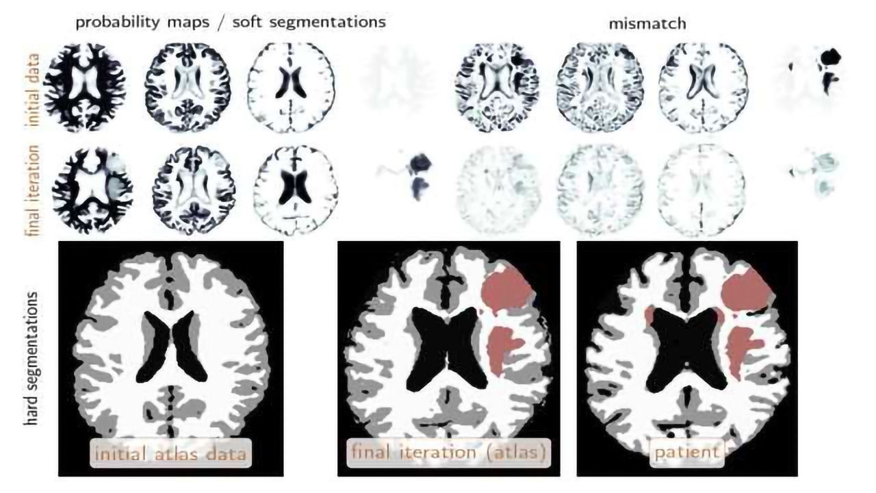Ability to Identify Brain Tumors Using Machine Learning
