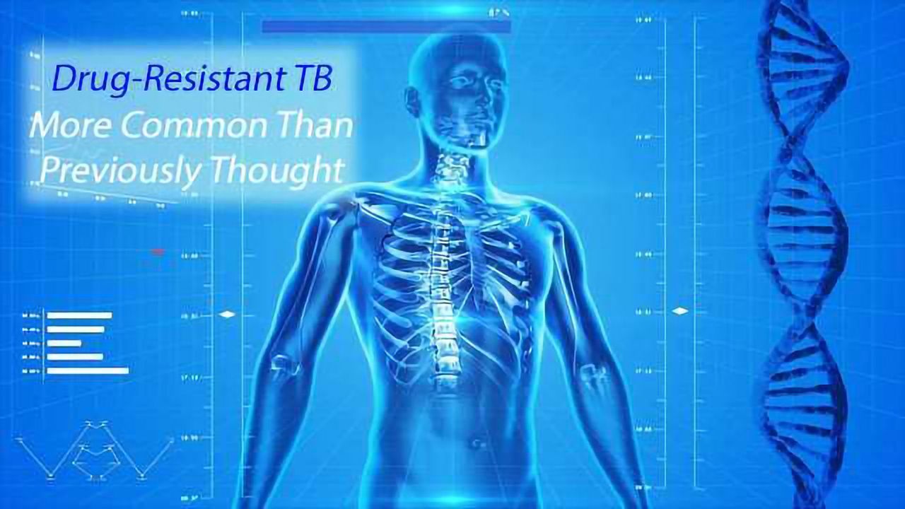 Next Gen Sequencing Test Enables Precise Identification of Drug-Resistant TB