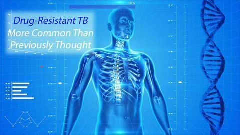 Next Gen Sequencing Test Enables Precise Identification of Drug-Resistant TB