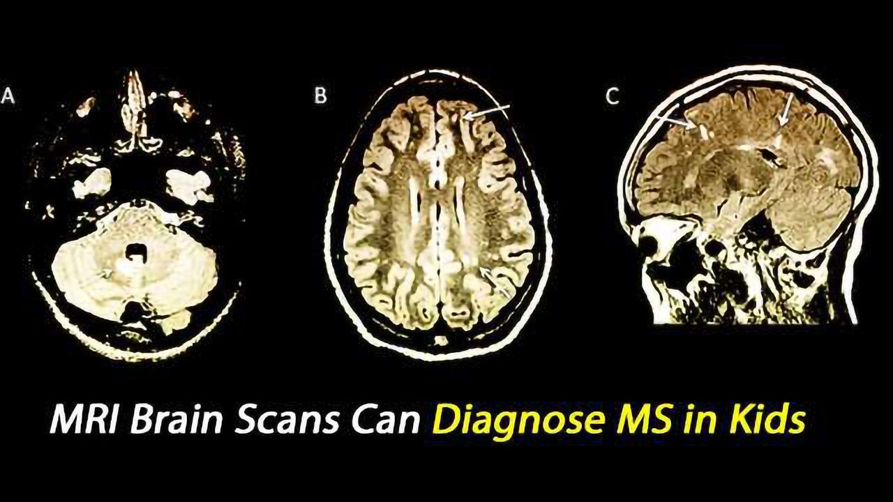 MRI Brain Scans Can Spot MS in Kids