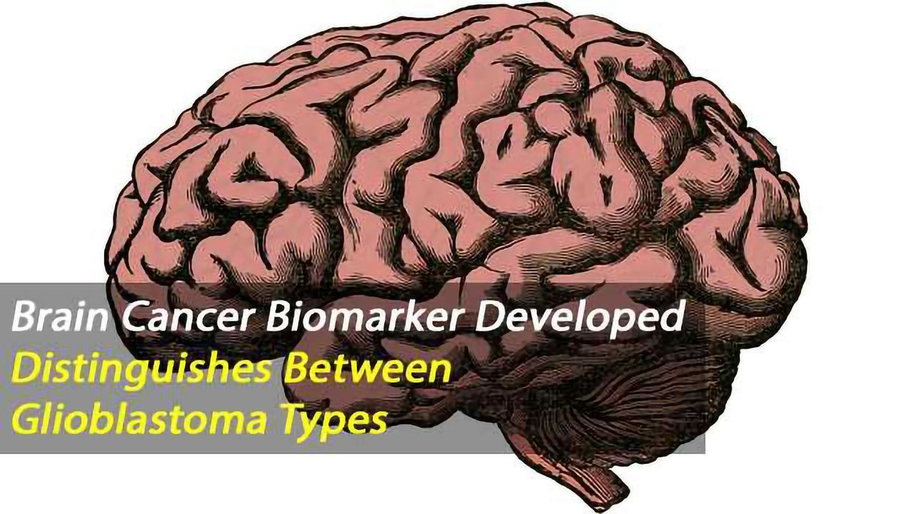 Biomarker for Glioblastoma Predicts Clinical Course and Sensitivity to Treatment